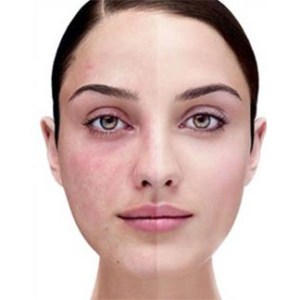 Treatment-of-Acne-Rosacea Acne Scar Treatment
